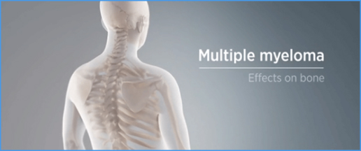 Knochenumbau-beim-multiplen-Myelom