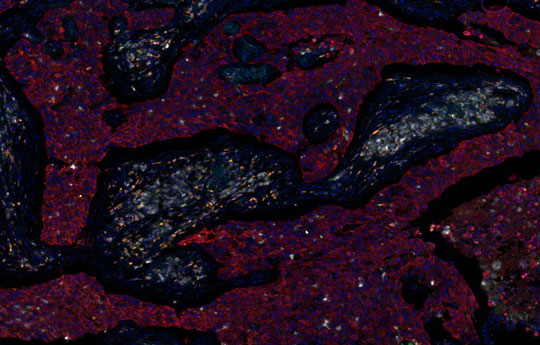 biomarker-fgfr2-bei-gastrointestinalen-tumoren