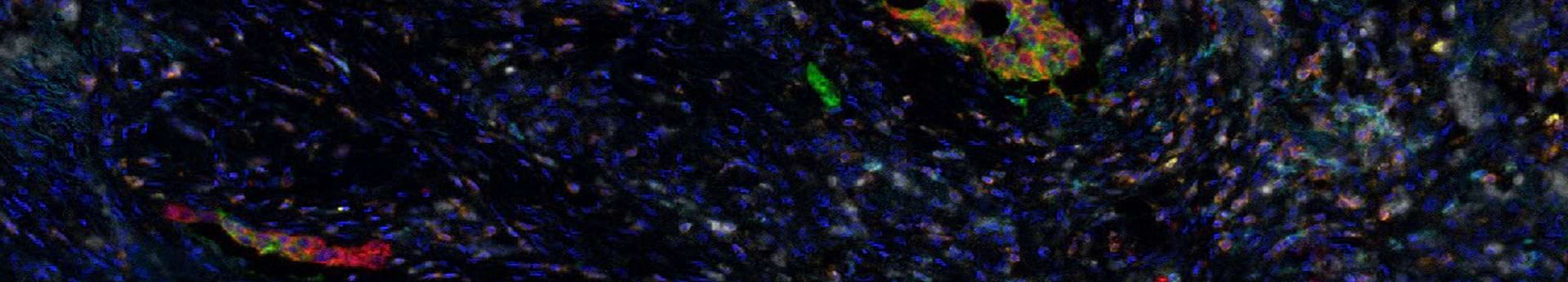 biomarker-fgfr2-bei-gastrointestinalen-tumoren