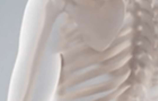 knochenumbau-beim-multiplen-myelom