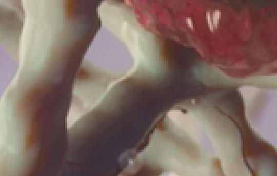 minimale-resterkrankung-beim-multiplen-myelom-und-der-akuten-lymphatischen-leukamie